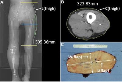 The turbocharged wide anterolateral thigh perforator flap to reconstruct massive soft tissue defects in traumatized lower extremities: A case series